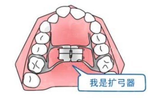 正畸扩弓示意图