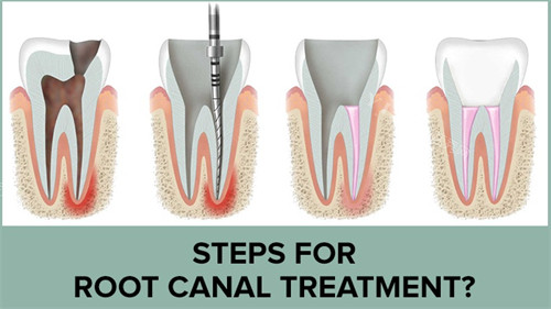 根管治疗手术过程