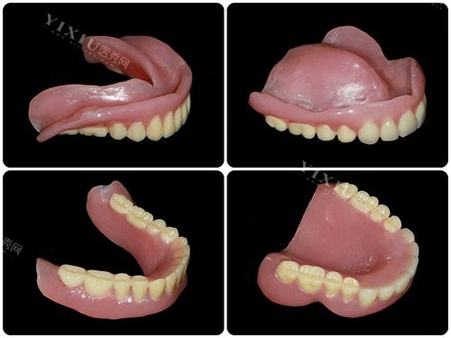 全口吸附性义齿实物展示图