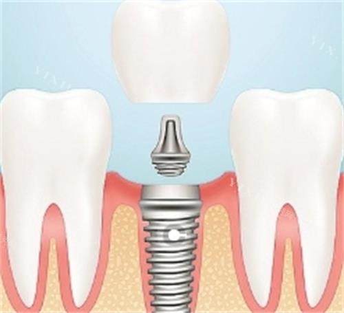 种植牙的组成部分