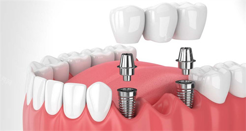 在口腔内进行种植牙