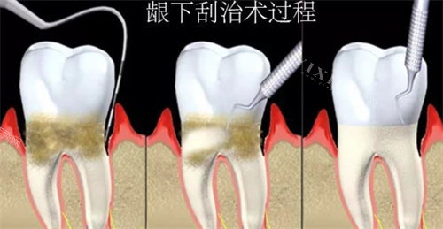 龈下刮治过程