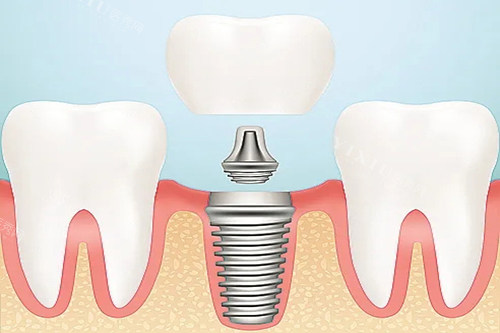 口腔种植牙卡通示意图