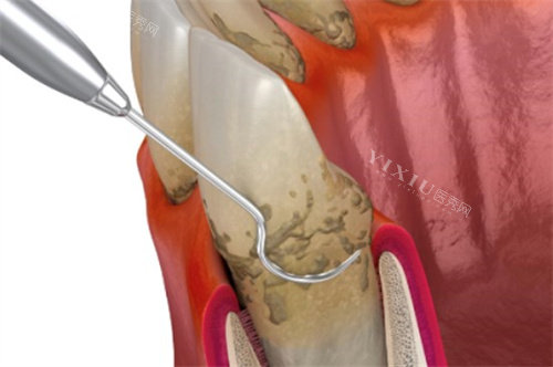 龈下刮治是什么