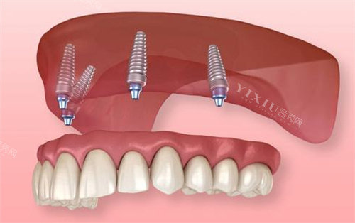 半固定种植牙动画图