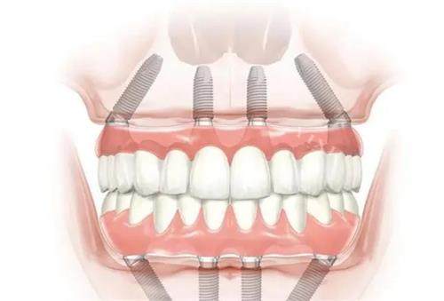 全口种植牙的示意图