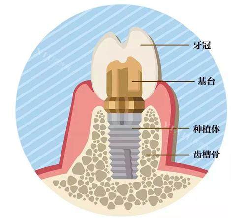 种植牙的组成
