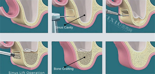 上颌窦提升手术过程