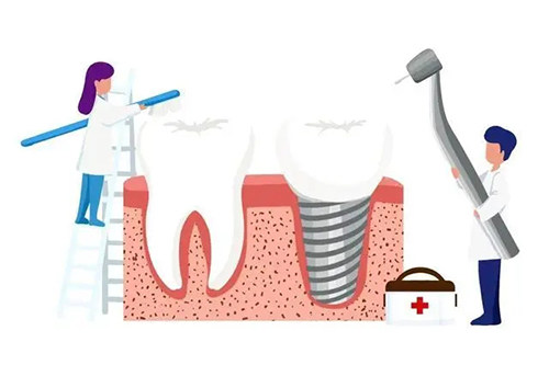短种植体有哪些品牌？短种植体有美国百康、诺贝尔Speedy以及奥齿泰TS3 SA等！(图6)