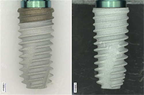 短种植体有哪些品牌？短种植体有美国百康、诺贝尔Speedy以及奥齿泰TS3 SA等！(图5)