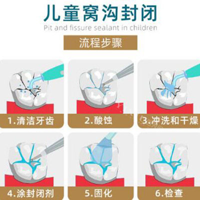 儿童口腔窝沟封闭步骤