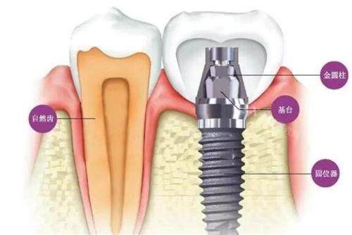 韩国奥齿泰TS3种植体好不好？具有良好的稳定性和耐用性，是纯钛材质(图3)