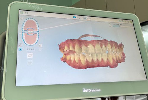 正畸口扫展示图