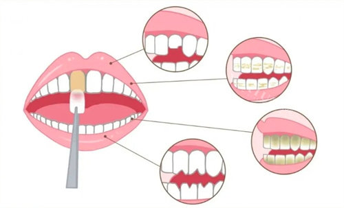 牙齿贴面示意图