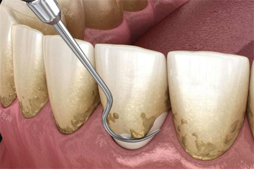 龈下刮治操作图
