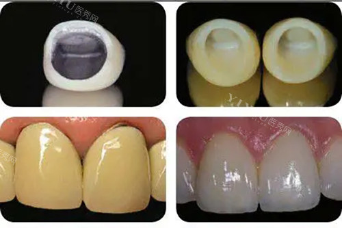 烤瓷牙冠和全瓷牙冠安装前后对比