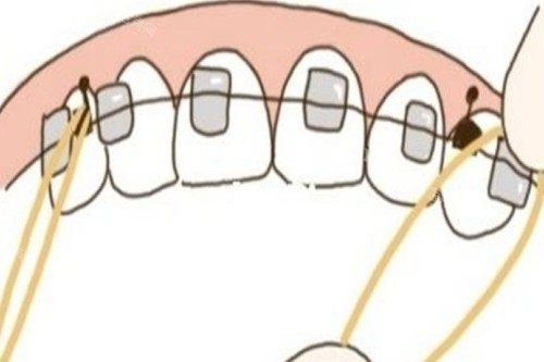 牙齿传统矫正卡通图