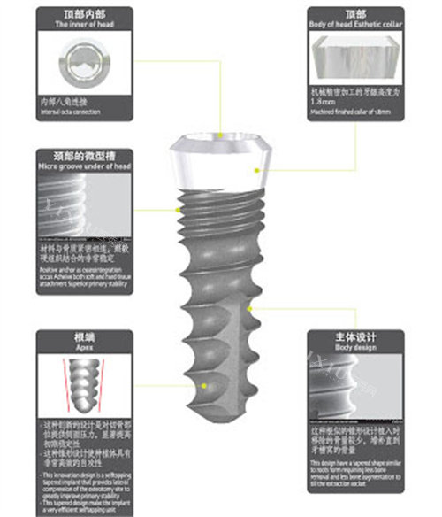 韩国SG种植体详细介绍