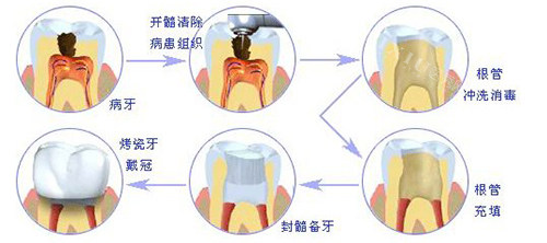 根管治疗过程示意图