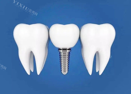 康盛种植体是哪国的品牌？国产品牌，‌性价比高价格在5000-10000元左右‌(图4)