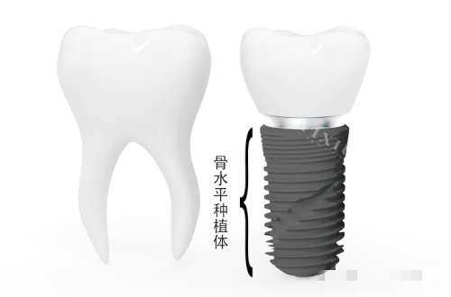 种植体骨水平图片