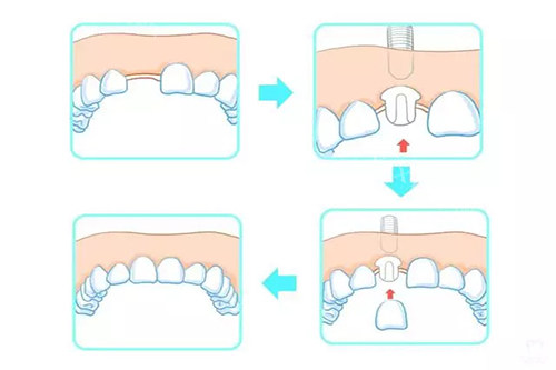 康盛种植体是哪国的品牌？国产品牌，‌性价比高价格在5000-10000元左右‌(图1)