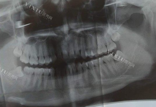 杭州临平区附近牙齿拍片多少钱一次？小牙片／全口曲面平展／牙齿CT收费分享！(图1)