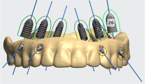 韩国八维种植牙特点揭秘，收费不贵满意度高更具性价比！(图4)