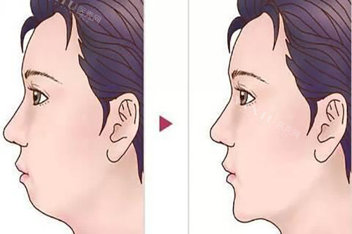 线上查！2025盘锦牙齿矫正大概要花费多少钱？金属矫正4980+／自锁矫正9000+／半隐形矫正13000+(图2)