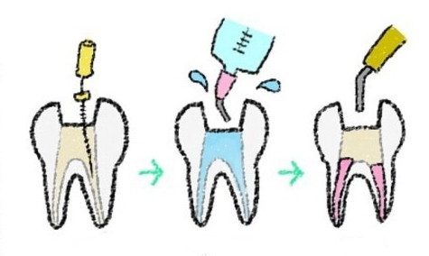 大医院为啥不建议打牙桩？有医生说：根管治疗后千万别打桩(图2)
