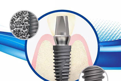 韩国仕诺康种植牙质量咋样？一文读懂种植体特点和优势助你更好选择！(图1)
