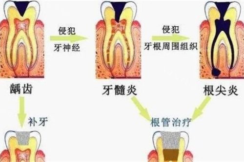 牙髓炎的治疗方法