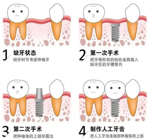 种植牙后的成效