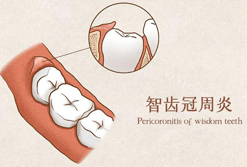 智齿冠周炎漫画示意图