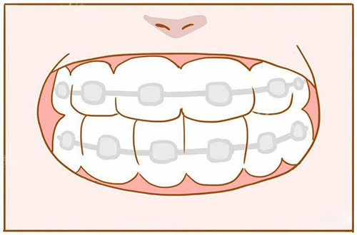 牙齿矫正漫画展示图