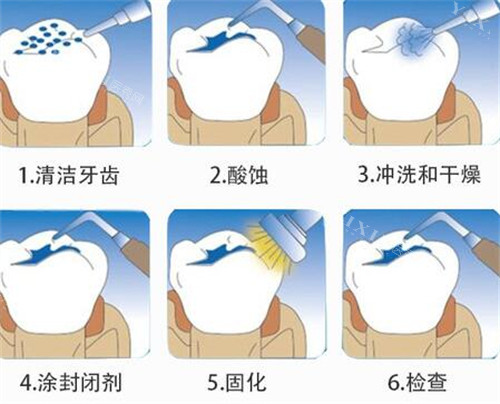 洗牙的过程步骤