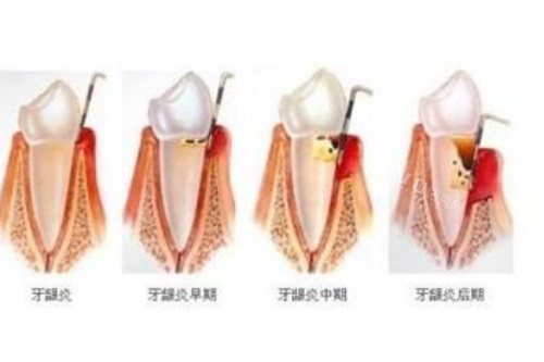 牙髓炎的发展过程