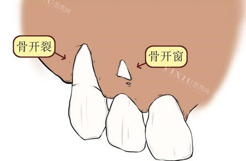 骨开窗卡通示意图