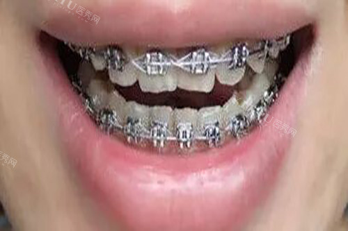 荣成牙齿矫正哪里好？网友特别推荐这几家：袁建方口腔／振华口腔／周春敏口腔／刘宏帅口腔／美臻口腔(图3)