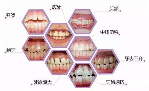 牙齿矫正适应症展示图