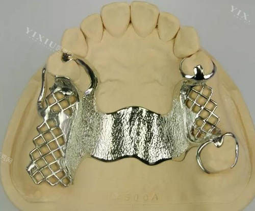 钢托义齿戴着舒服吗？和胶托义齿相比都有哪些特点？(图3)