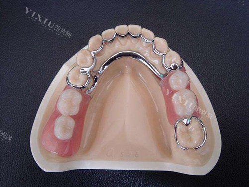 钢托义齿戴着舒服吗？和胶托义齿相比都有哪些特点？(图4)