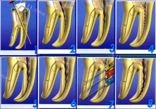 根管治疗步骤图细节