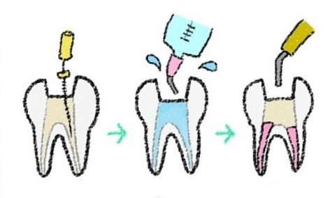 根管治疗过程漫画图