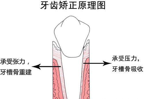 牙齿矫正正畸原理