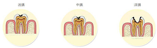 浅龋中龋深龋示意图