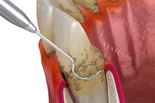 问答！怎么判断是不是根尖周炎？牙根尖炎好的治疗方法有哪些？(图3)