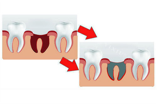 正常牙窝和干槽症牙窝对比