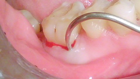 问答！怎么判断是不是根尖周炎？牙根尖炎好的治疗方法有哪些？(图2)