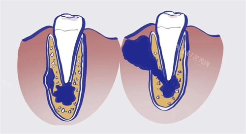根尖周炎卡通图展示照片